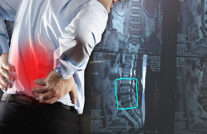 治療腰突最有效的方法 治療腰突最有效的方法