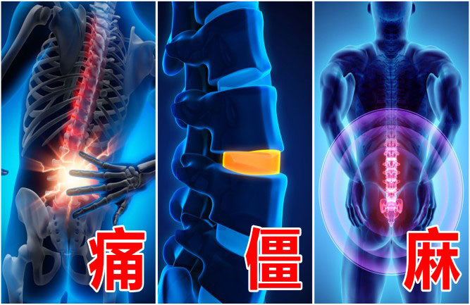 緩解腰椎間盤突出較好的治療方法 緩解腰椎間盤突出較好的治療方法